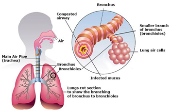 COPD