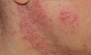 Eczema
