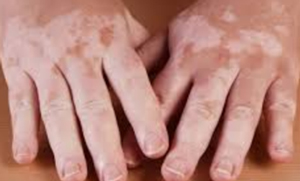 Leucoderma