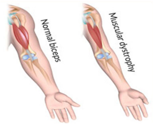 MUSCULAR DISTROPHY