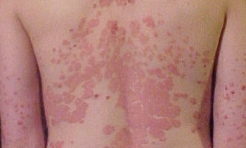 PSORIAIS
